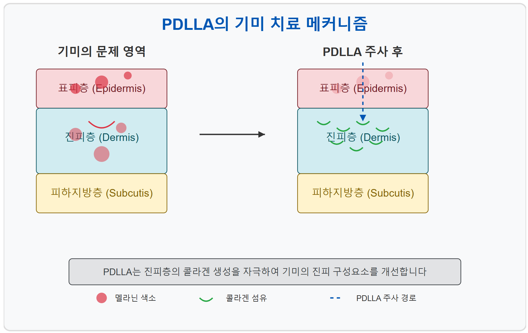 기미 치료 – 쥬베룩 주사의 효능