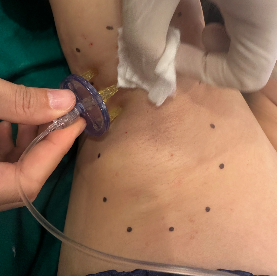 Miradry Anesthesia