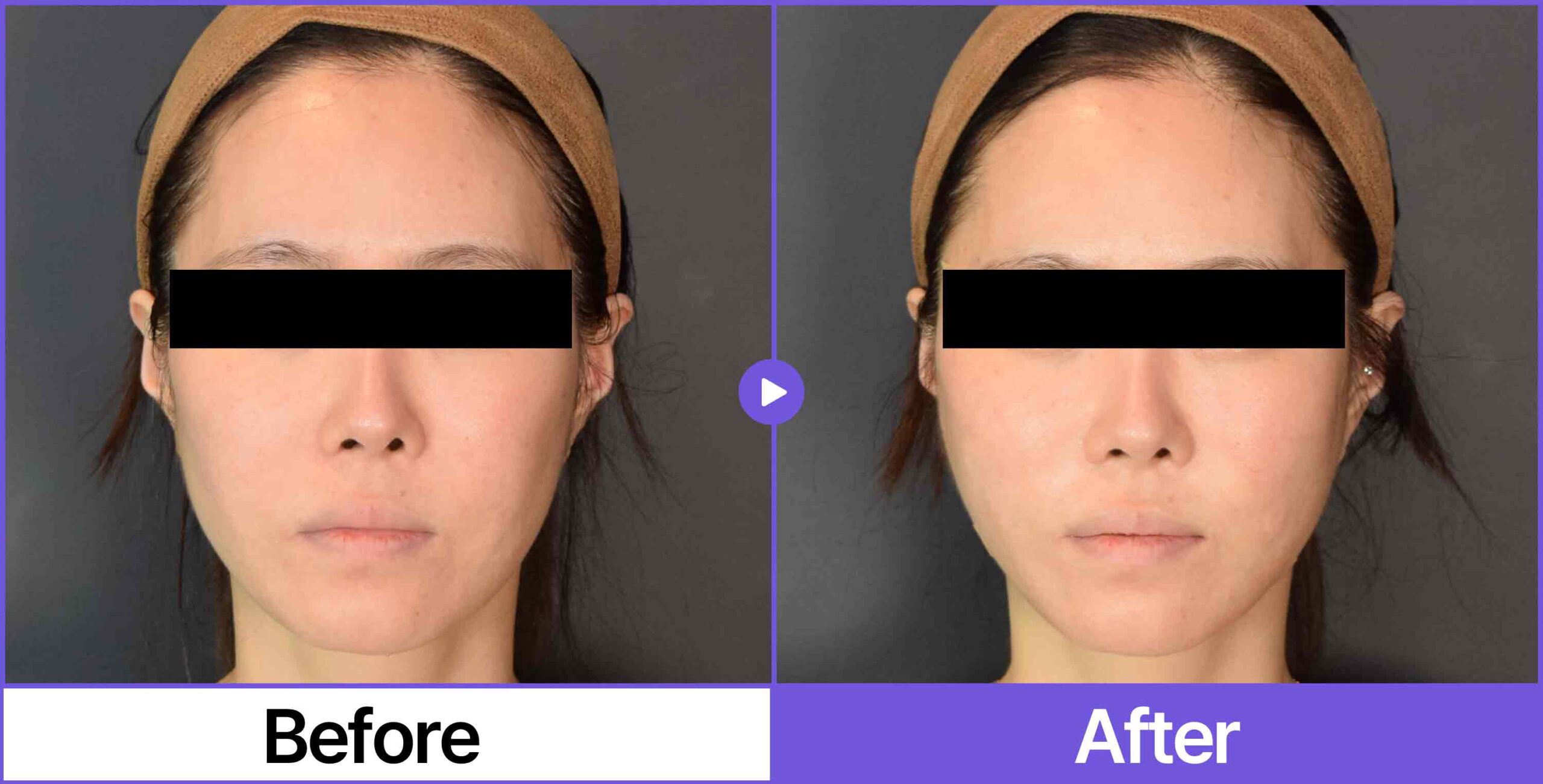 Silhouette soft: a comparison of a woman's face